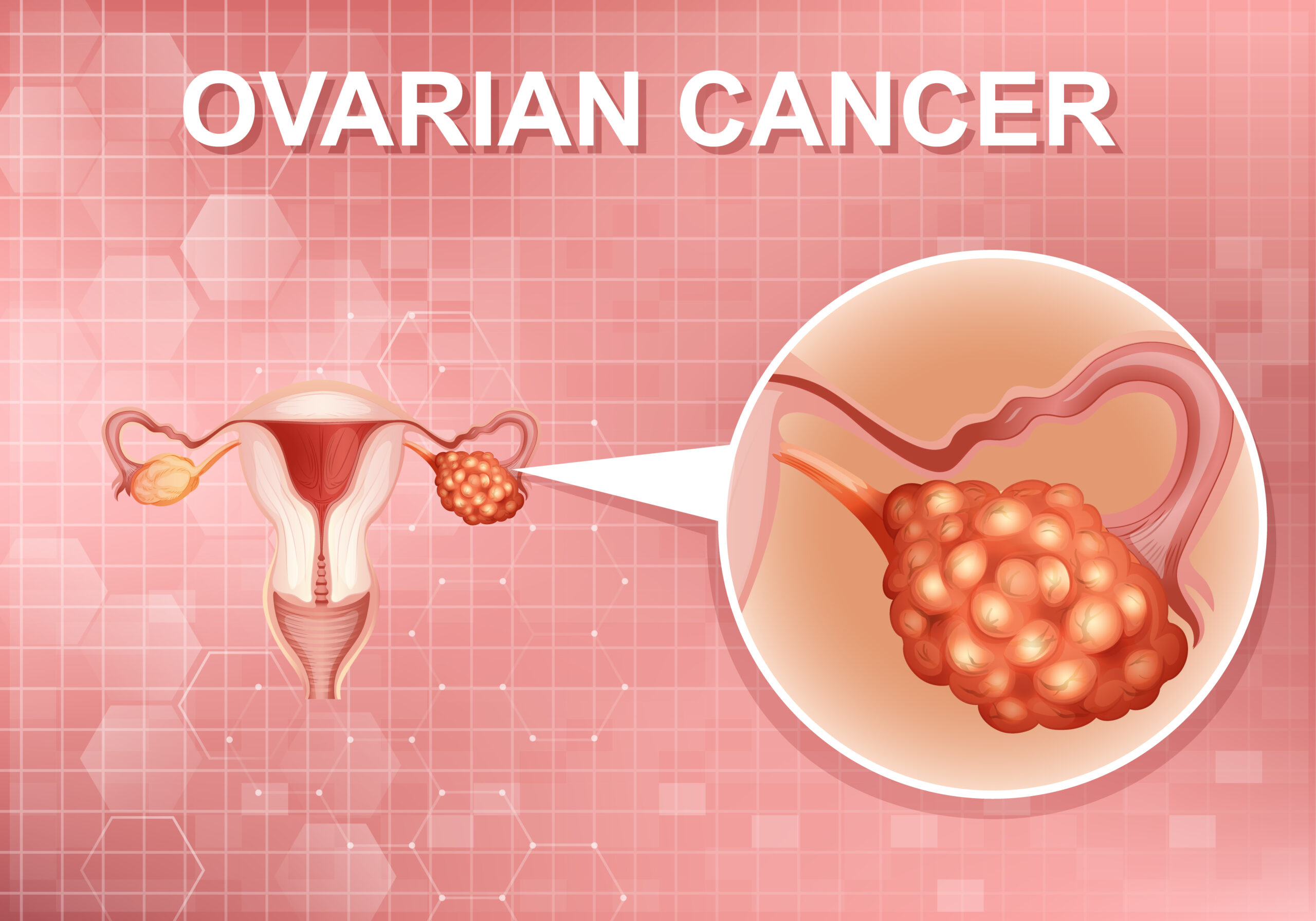 Read more about the article 7 ways – How to Detect Ovarian Cancer Early Symptoms Without Test